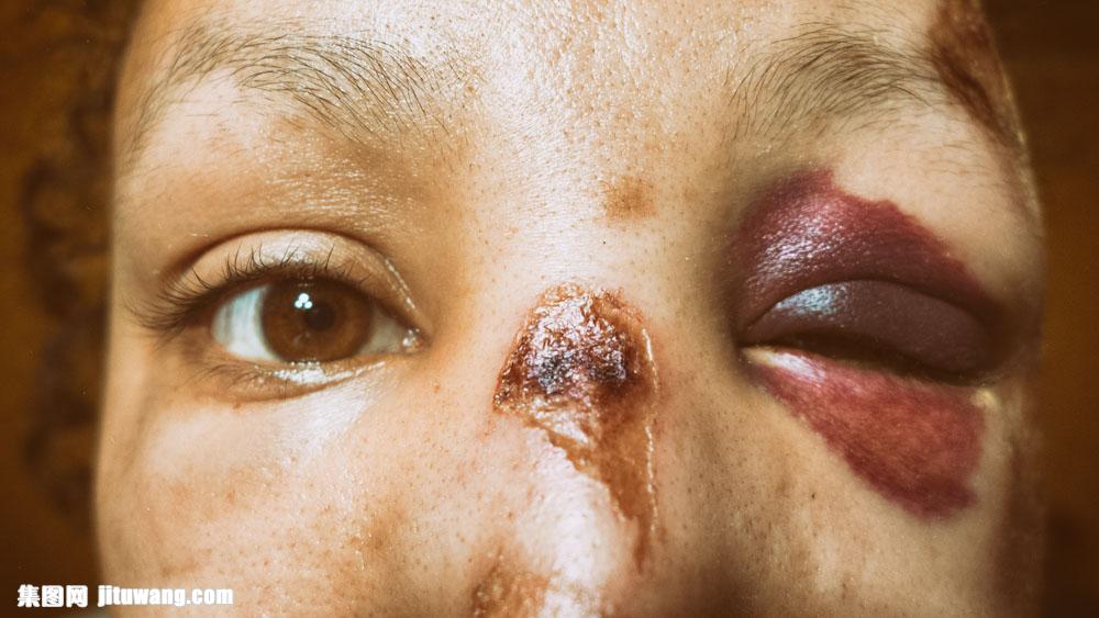 伤痕 收藏 关键词:女子面部的伤痕图片下载,女子,面部,伤痕,红肿,伤疤